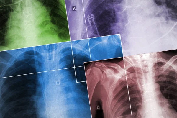 Set of the X-ray images of patients chests in the different colo — Stock Photo, Image