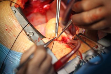 Kalp ameliyatının süreci. Cerrahlar ameliyat alanında aletlerle çalışırlar..
