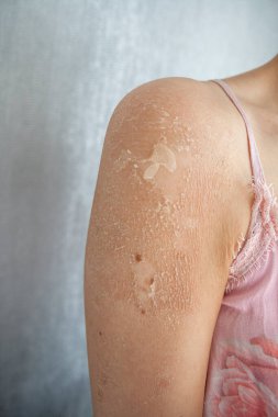 Egzama (dermatit), alerji, sedef, mantar, kuru ya da yanmış cilt. Omuzdan yaklaş. Sağlık hizmeti kavramı.