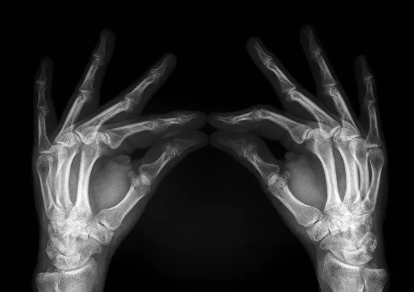 Röntgenaufnahme zweier Hände — Stockfoto