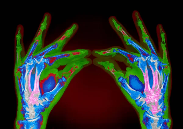 Ręce tomografia komputerowa Symulacja obrazu — Zdjęcie stockowe