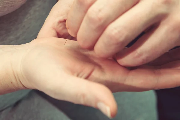 chinese medical doctor performs acupuncture on a patients arm