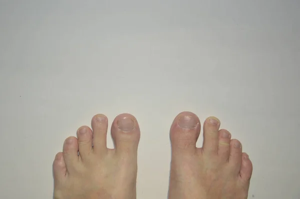 Old and sore feet of men and women on a white background