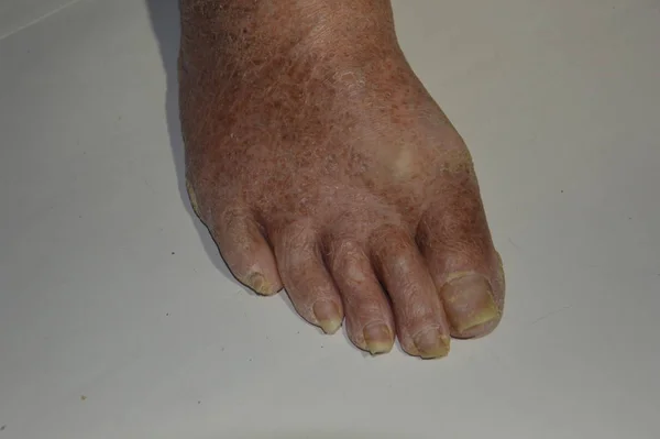 Velhos e doloridos pés de homens e mulheres em um fundo branco — Fotografia de Stock