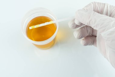 Kontrol edin, rutin idrar tahlili, idrar tahlili için ayırıcı. 