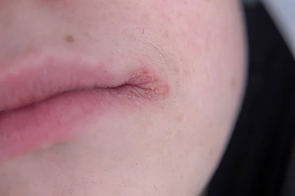Atópiás Dermatitis. lány atópiás dermatitis tünet a bőr az arcon. Koncepció allergiát — Stock Fotó