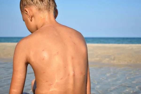 Insect bites on his back. Inflammation in the back of the child. beach tongs