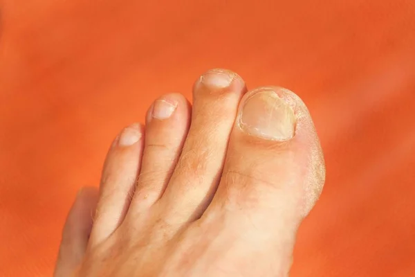 Fliegen auf den Fingern. Nahaufnahme eines schlechten Nagelfingers. Nagelpflege am Fuß - Pediküre. — Stockfoto