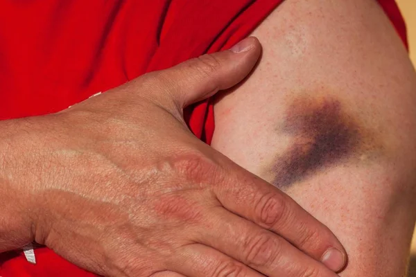 Grote blauwe plek op de mannelijke handen. Pijnlijke ongeval. Linker arm gewond. — Stockfoto