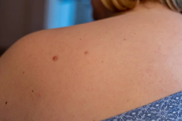 Woman with birthmarks on her skin, Skin tags removal.