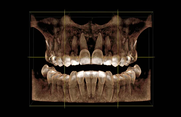 Visualisatie Van Een Computer Tomogram Van Tandheelkunde Vooraanzicht — Stockfoto