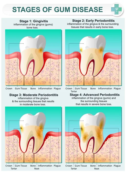 Stage of Gum Disease — Stock Vector