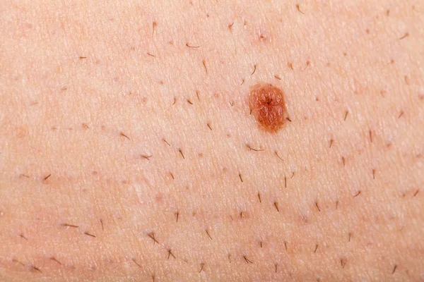 Znamię na ogolone ludzkiej skóry — Zdjęcie stockowe