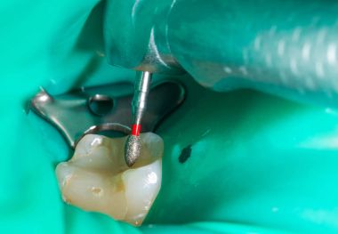Endodontik yordamı kapat