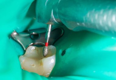Endodontic procedure close up clipart
