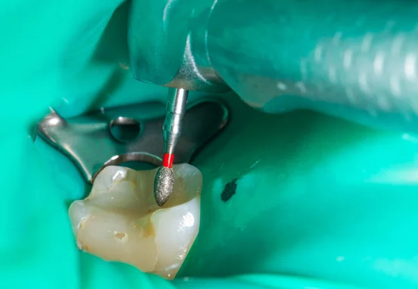 Endodontische Verfahren hautnah — Stockfoto