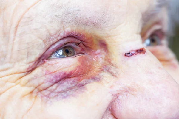 노인 여성 부상 — 스톡 사진