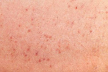 Folliculitis on human skin clipart