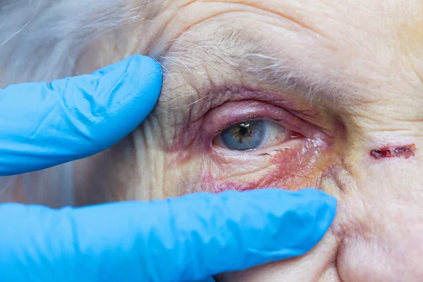 Ochiul rănit al unei femei în vârstă și degetele asistentei medicale — Fotografie, imagine de stoc