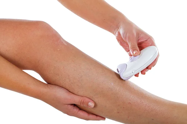 Varicose veins on woman's leg & epilator — Stock Photo, Image