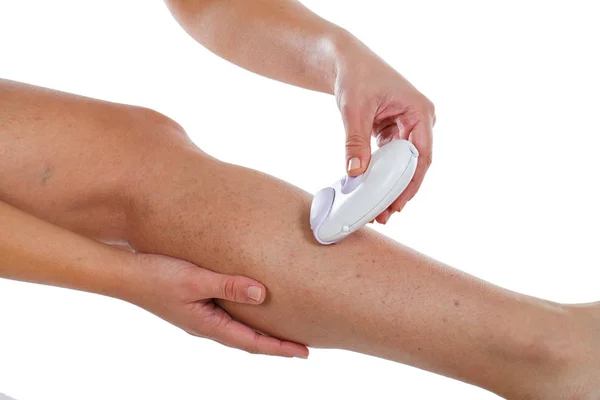 Spataderen op vrouw been & epilator — Stockfoto