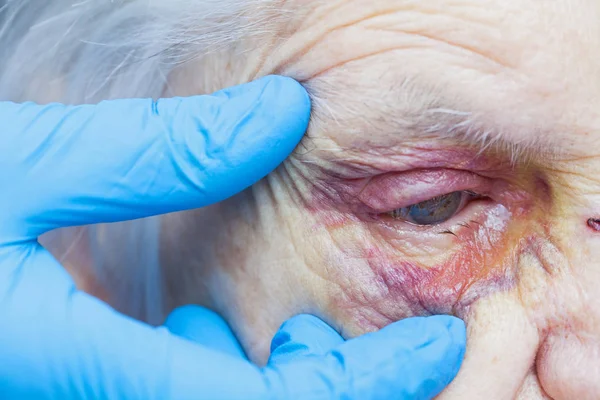 Ojo lesionado de la mujer anciana y dedos de enfermera —  Fotos de Stock