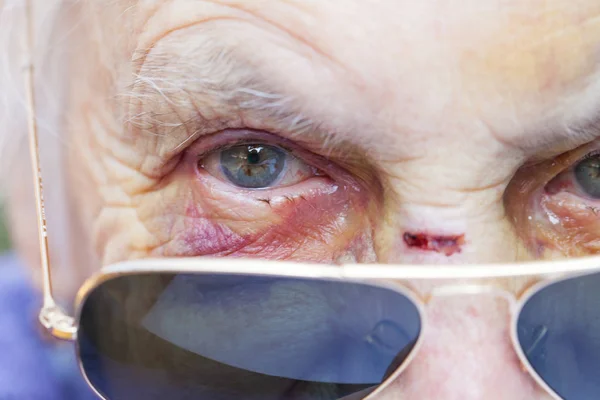 Injured elderly woman's face — Stock Photo, Image