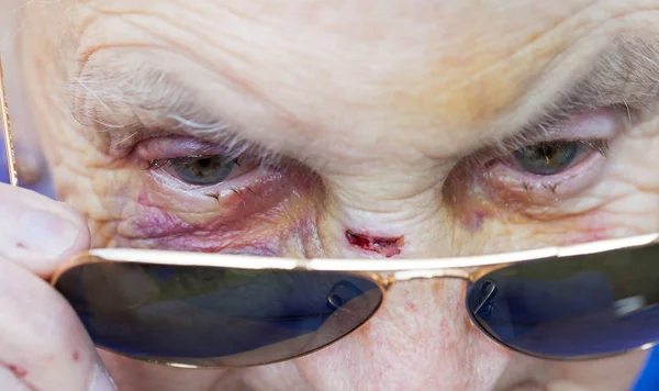 Injured elderly woman's face — Stock Photo, Image