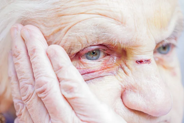 Injured elderly woman's eyes & face — Stock Photo, Image