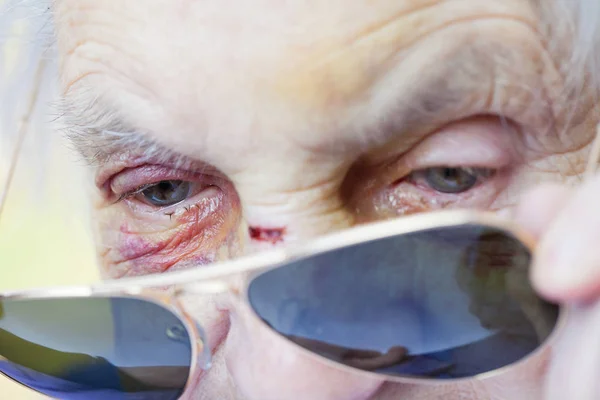 Injured elderly woman's face — Stock Photo, Image