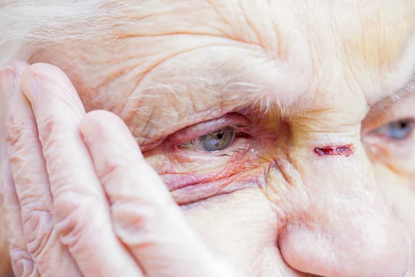 Injured elderly woman's eyes & face — Stock Photo, Image