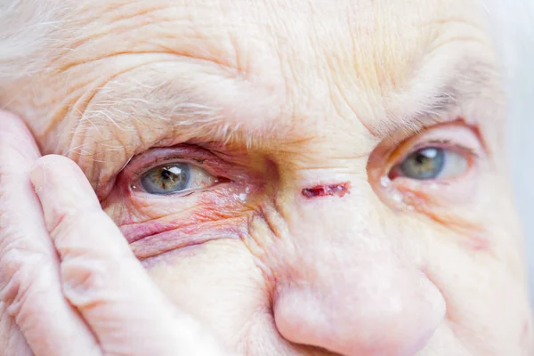 Injured elderly woman's eyes & face — Stock Photo, Image