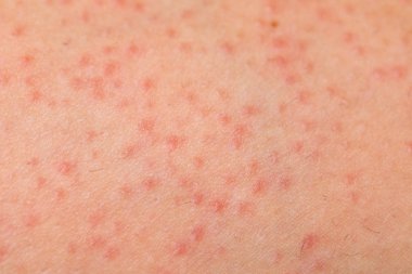 Folliculitis on female skin clipart