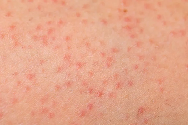 Folliculitis 여성 피부에 — 스톡 사진