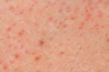 Folliculitis on female skin clipart