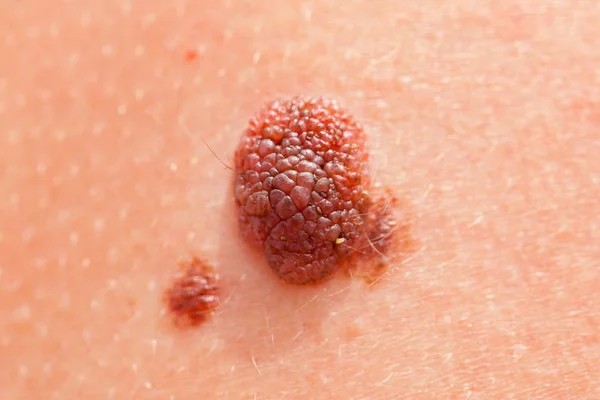 Barna nevus emberi bőrön — Stock Fotó