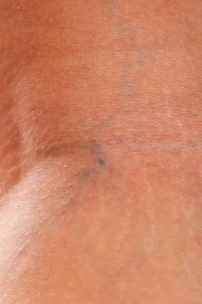 Veias varicosas na perna feminina — Fotografia de Stock