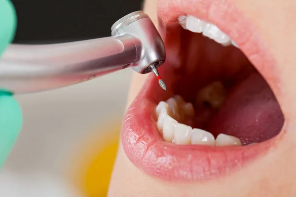 Tratamento dentário de perto — Fotografia de Stock