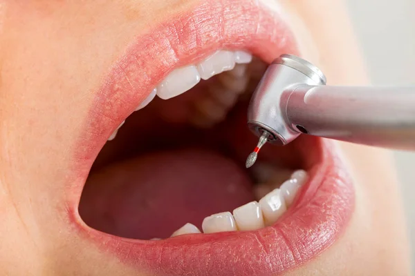 Лечение зубов вблизи — стоковое фото
