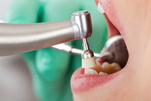 Limpieza dental profesional — Foto de Stock