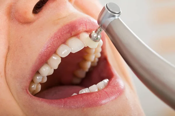 Pulizia dentale professionale — Foto Stock