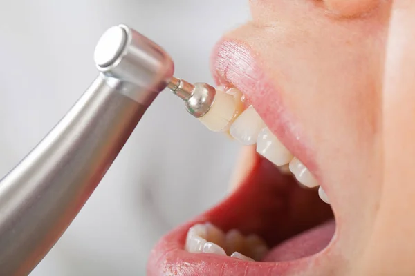 Профессиональная чистка зубов — стоковое фото