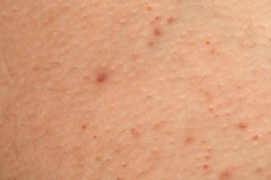 İnsan derisindeki folikül iltihabının yakın resmini çek - hormonal dengesizlik
