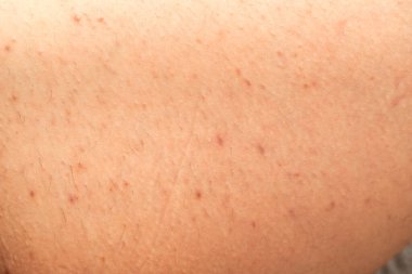 İnsan derisindeki folikül iltihabının yakın resmini çek - hormonal dengesizlik