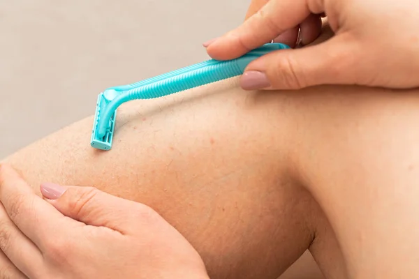 毛包炎と彼女の毛深い足を剃る かみそりを保持する女性のクローズアップ写真 — ストック写真