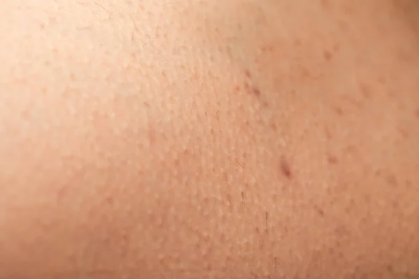 Κοντινή Εικόνα Της Θυλακίτιδας Στο Ανθρώπινο Δέρμα Ορμονική Ανισορροπία — Φωτογραφία Αρχείου