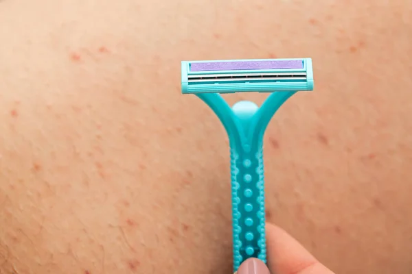 毛包炎と彼女の毛深い足を剃る かみそりを保持する女性のクローズアップ写真 — ストック写真