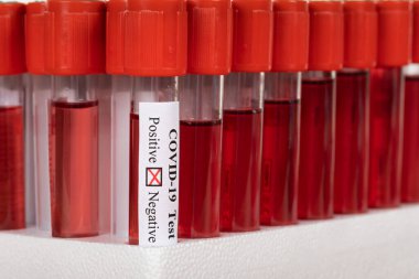 Biyolojik laboratuvarda Coronavirus kan örnekleri - pozitif test sonuçları
