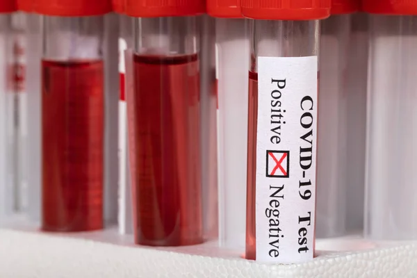 Δείγματα Αίματος Του Coronavirus Βιολογικό Εργαστήριο Θετικά Αποτελέσματα Δοκιμών — Φωτογραφία Αρχείου