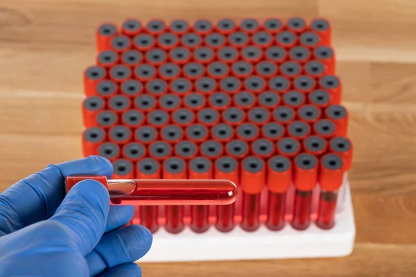 Coronavirus blood samples in biological laboratory - positive test results